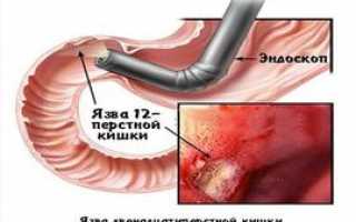 Аналоги флюдитека подешевле — список, какой препарат для замены лучше