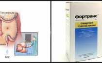 Этапы подготовки к колоноскопии Фортрансом, если процедура утром