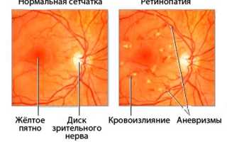 Фоновая ретинопатия и ретинальные сосудистые изменения