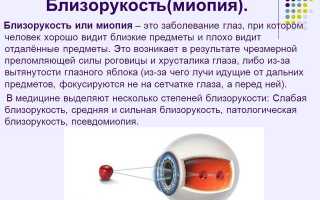 Миопия слабой степени — что это?