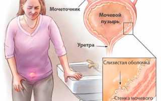 Целебные ванночки для облегчения симптомов цистита у женщин: когда делать и как правильно