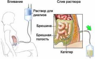 Показания и противопоказания диализа: что это такое и как проходит процедура?