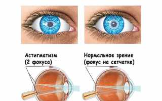 Чем опасен астигматизм глаз: первые признаки и современные методы лечения