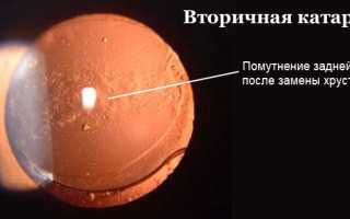 Лечение вторичной катаракты после замены хрусталика