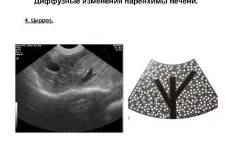 Признаки диффузных изменений печени