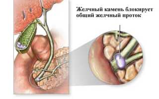 Причины повышения билирубина в анализе мочи: методы определения и норма показателей