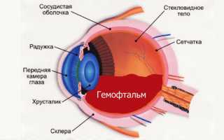 Гемофтальм – причины и лечение