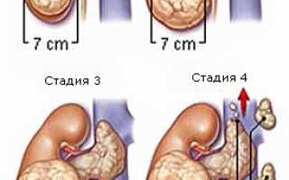 Опухоль надпочечников: характеристика заболевание и методы терапии