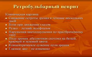 Ретробульбарный неврит зрительного нерва — в чем опасность заболевания